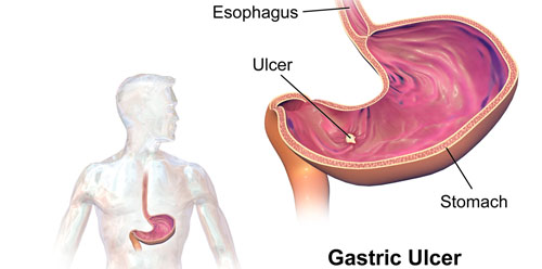 peptic ulcer