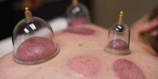 cupping therapy