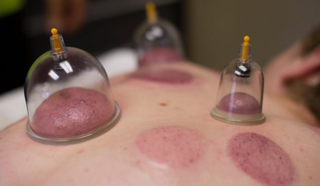 cupping1