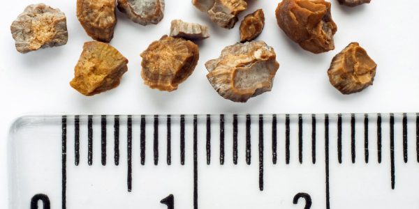 Kidney stones