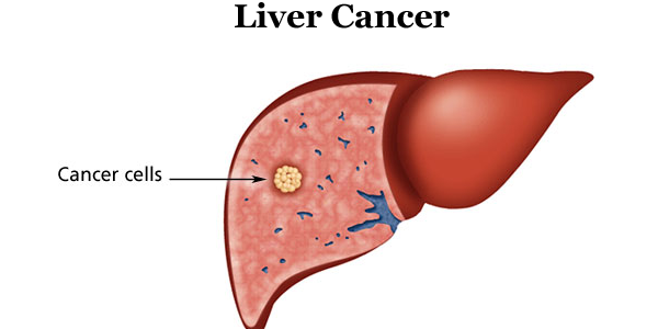 liver-cancer