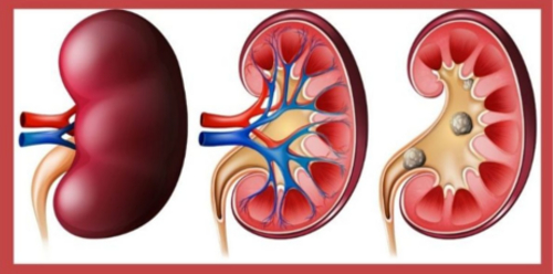 kidney-stones